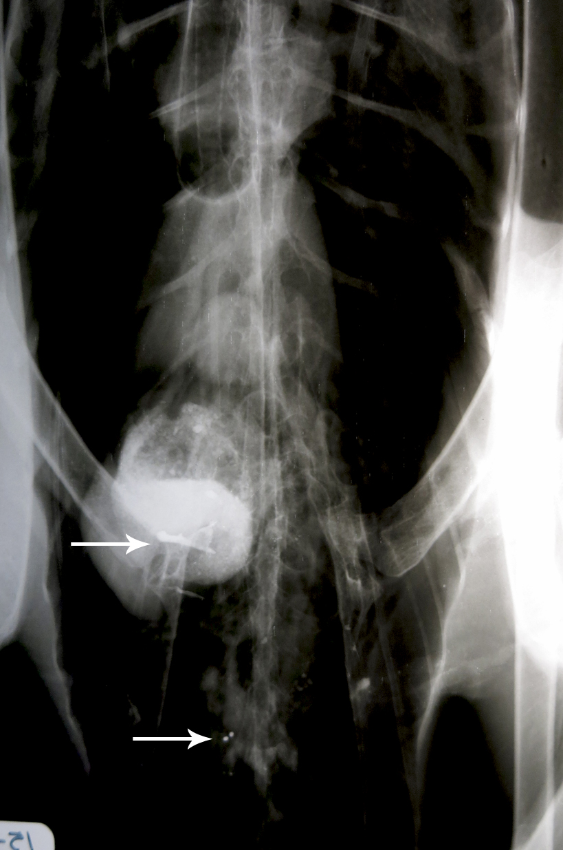 Radiograph with arrows pointing to lead fragments